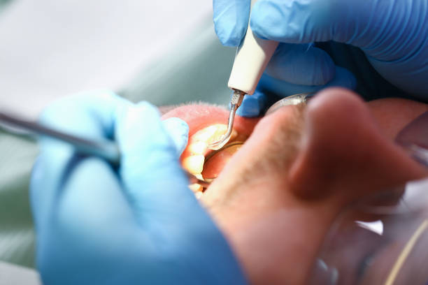 Best Emergency Treatment for Dental Infections or Abscesses in St Clair, MI