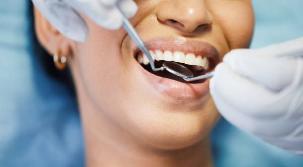 Best Emergency Dental Care for Broken or Chipped Teeth in St Clair, MI